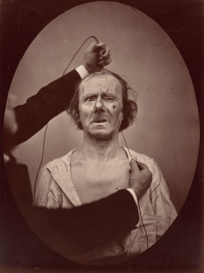 Electrical Excitation of m. zygomaticus minor and m. corrugator supercilii: Painful Weeping, c. 1856, plate 49 from The Mechanism of Human Facial Expression, published 1862
