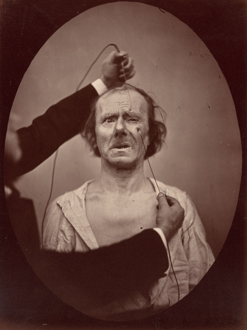 Electrical Excitation of m. zygomaticus minor and m. corrugator supercilii: Painful Weeping, c. 1856, plate 49 from The Mechanism of Human Facial Expression, published 1862